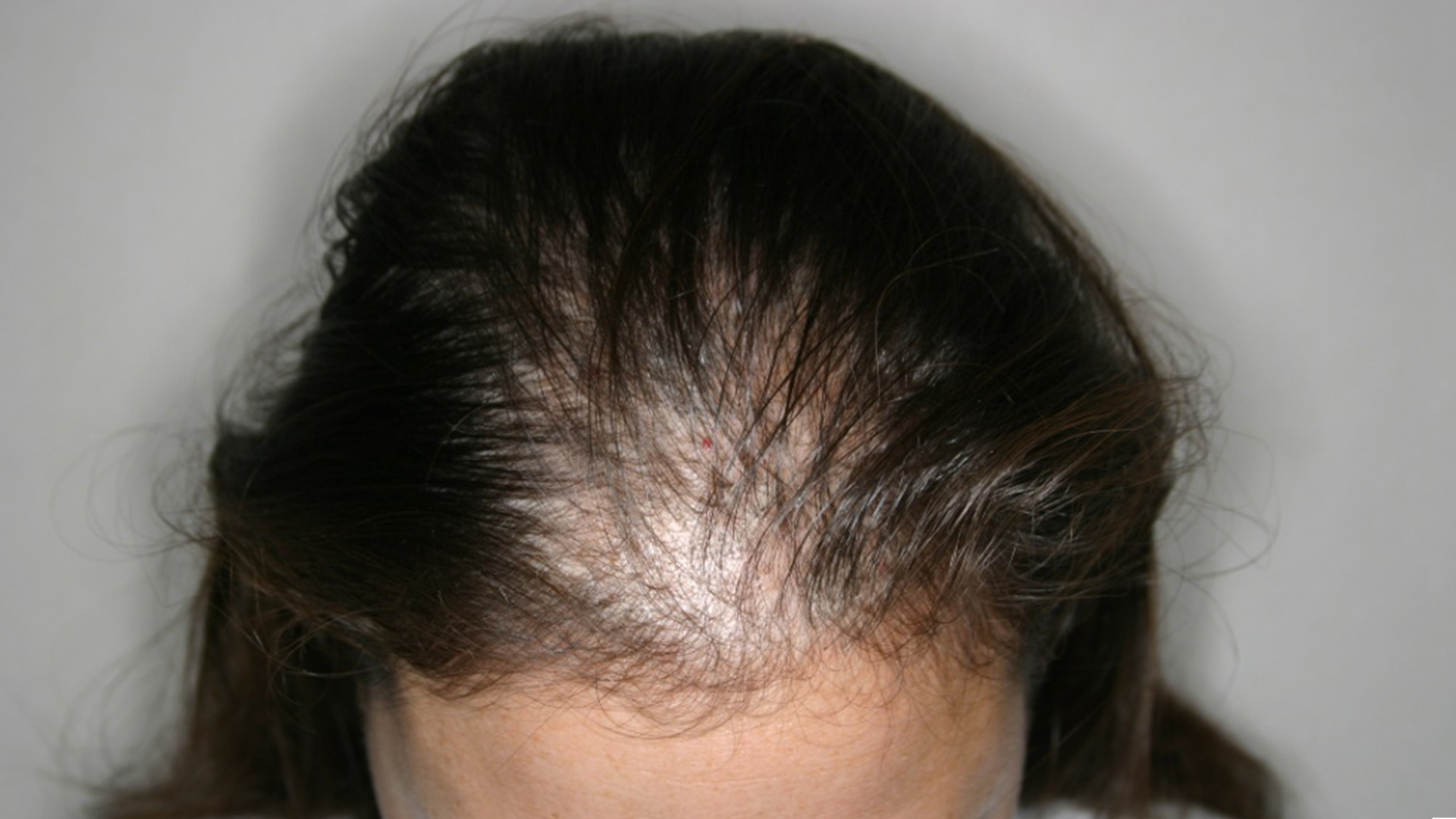 Алопеция у женщин лечение отзывы. Редкие волосы у женщин.